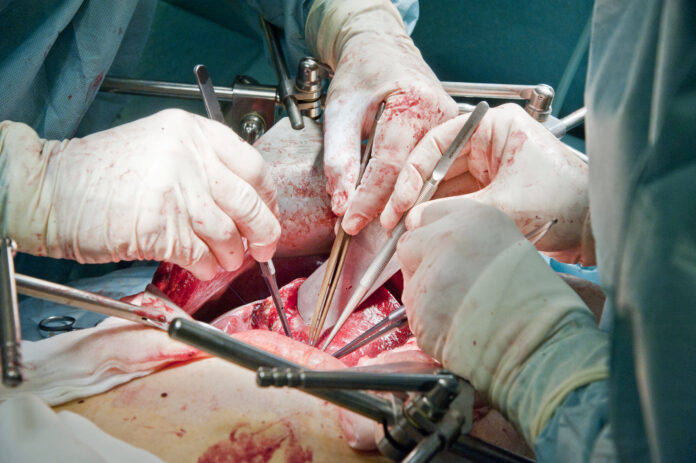 Liver Transplantations